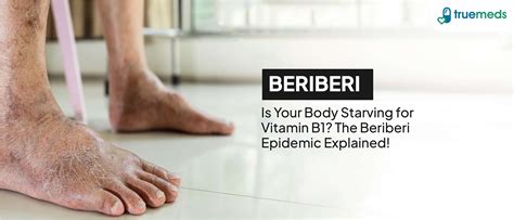beriberi pictures|The Causes and Treatment of Beriberi .